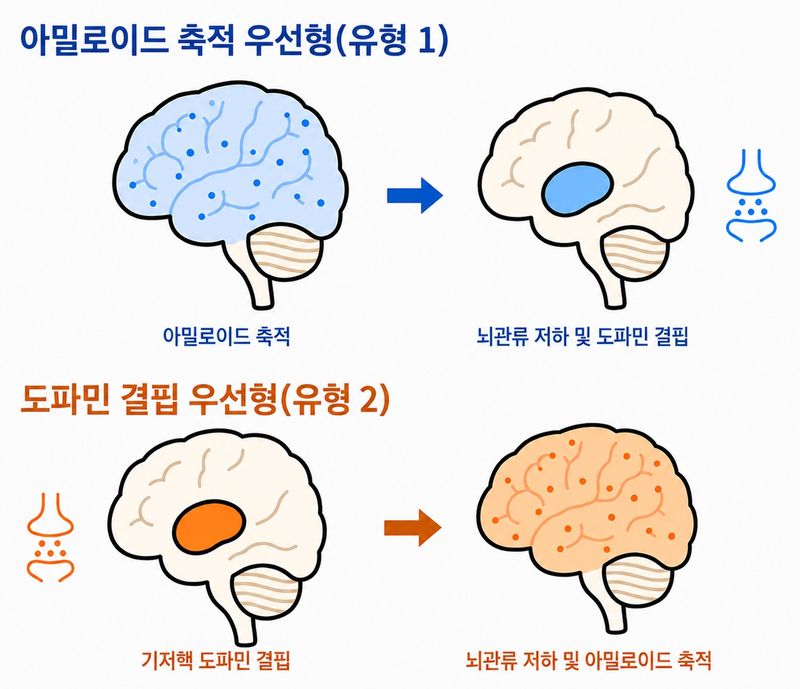 루이소체치매 진행유형 구분. 세브란스병원 제공