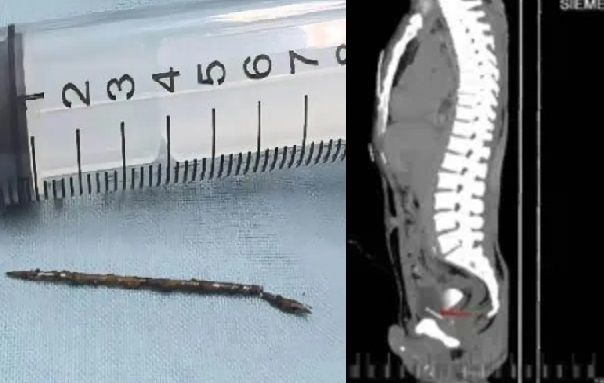 바늘처럼 생긴 물체를 자신의 몸에 삽입한 남성. 출처=뉴욕포스트