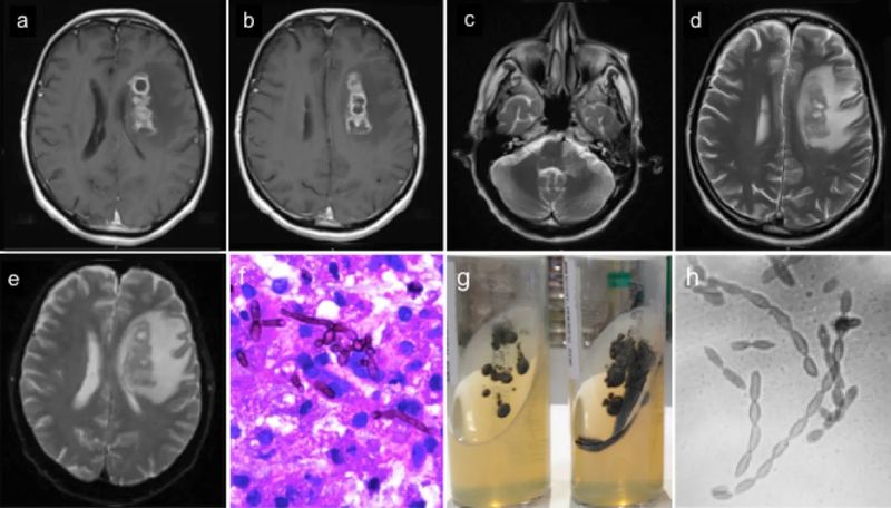 희귀한 뇌곰팡이에 감염된 67세 남성 환자의 MRI 사진. 출처=뉴욕포스트