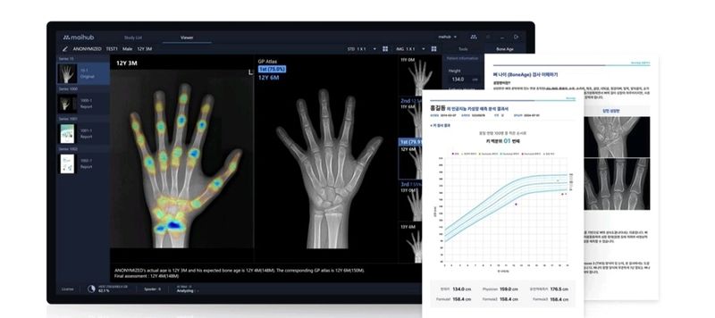 [서울=뉴시스] 17일 의료 AI 업계에 따르면 의료 AI 플랫폼 기업 마이허브는 지난해 9월 뷰노의 골연령 분석 솔루션 '뷰노메드 본에이지(VUNO Med-BoneAge)'를 인수한 이후 제품 고도화와 사용자 편의성 개선에 나섰다. (사진=마이허브 제공) 2026.10.16. photo@newsis.com *재판매 및 DB 금지