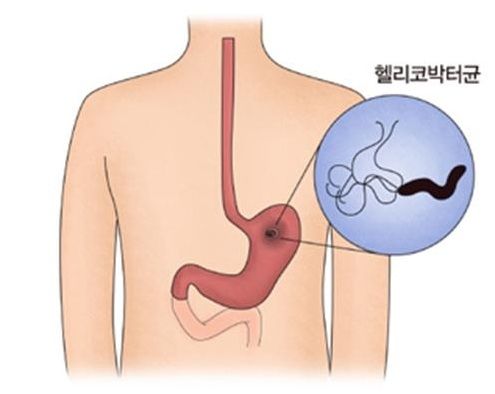 헬리코박터 제균, 여성이 불리… 높은 항생제 내성과 부작용이 원인 [헬스체크]